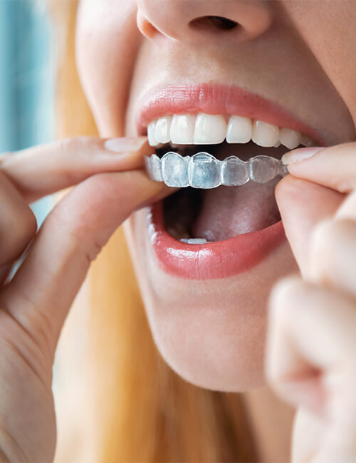 Close up shot of a woman holding invisalign