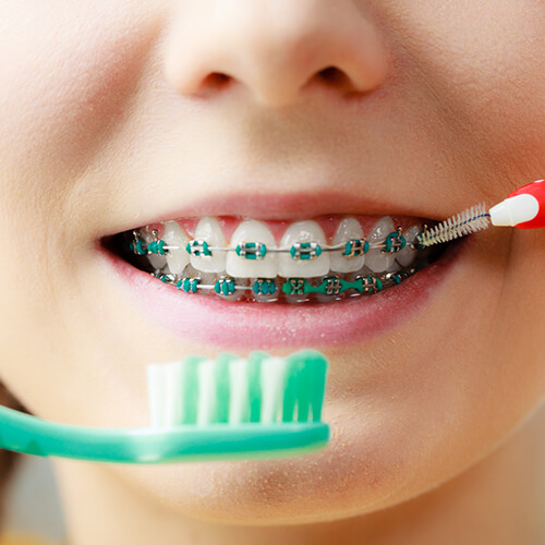 Close up shot of a mouth with braces being cleaned up