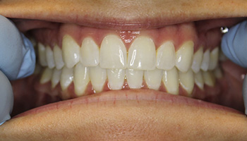 Close-up smile to show users how to submit for the virtual consultation
