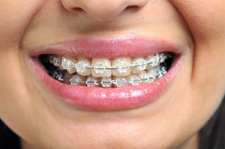 Types of Braces Offered at North Attleboro Orthodontics